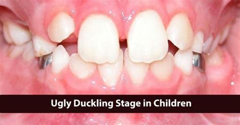 Ugly Duckling Stage