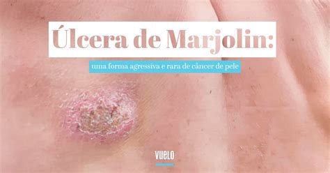 Ulcera De Marjolin