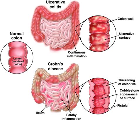 ulcerative colitis caused by ibuprofen