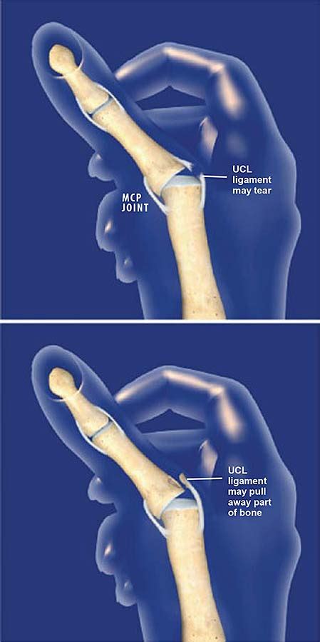 Ulnar Collateral Ligament Thumb Repair
