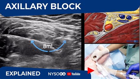 Read Online Ultrasound Guided Axillary Nerve Block 
