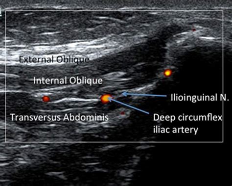 Download Ultrasound Guided Ilioinguinal Nerve Block 