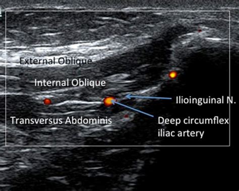 Read Ultrasound Guided Ilioinguinal Nerve Block 