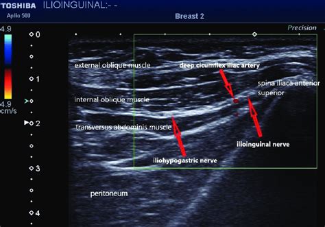 Read Online Ultrasound Guided Ilioinguinal Nerve Block File Type Pdf 