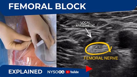 Download Ultrasound Guided Nerve Block Course 