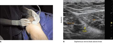 Read Ultrasound Guided Saphenous Nerve Block 