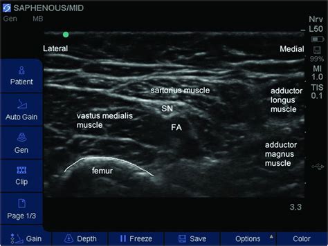 Read Ultrasound Guided Saphenous Nerve Block 