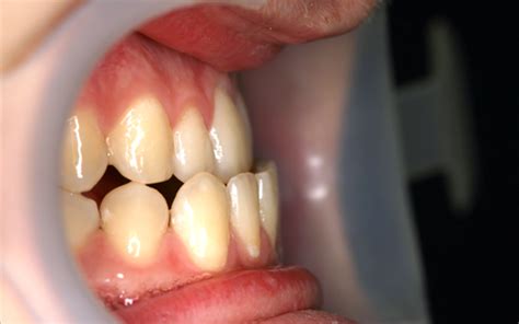 underbitt behandling