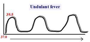 Read Undulating Fever Manual Guide 