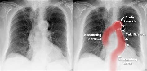 Unfolding Of Aorta
