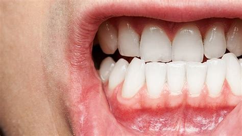 Unhealthy Gums And Teeth