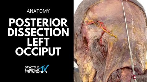 Upper Posterior Anatomy Spatial Dissection