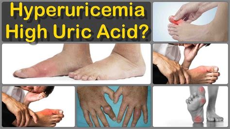uric acid adalah