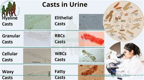 Urine Cellular Casts