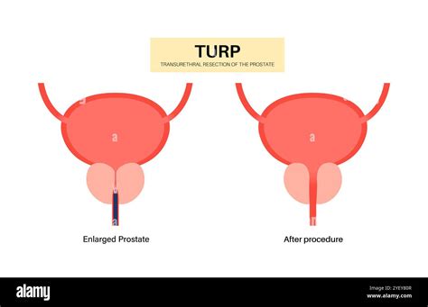 Urp Full Form