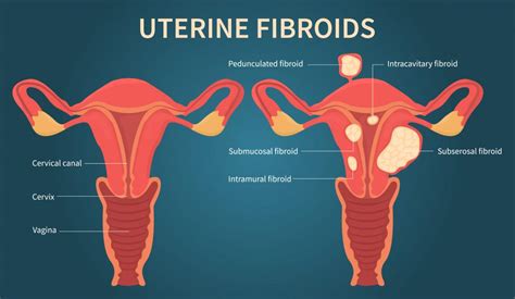 uterine fibroid 뜻