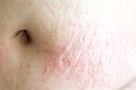 utslag  vid mage  bröst gravid