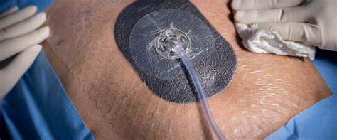 Vacuum Dressing Wound