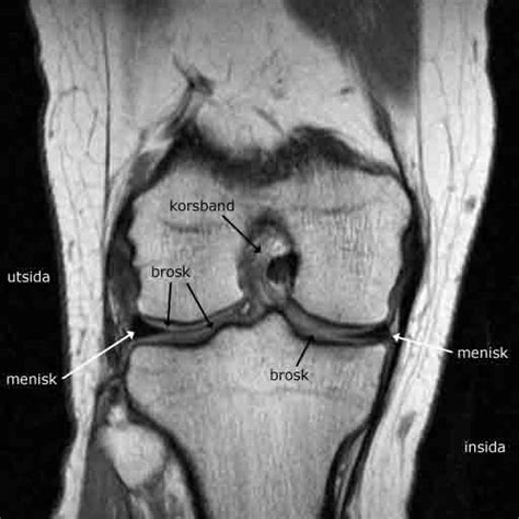 vad ser man på magnetröntgen knä
