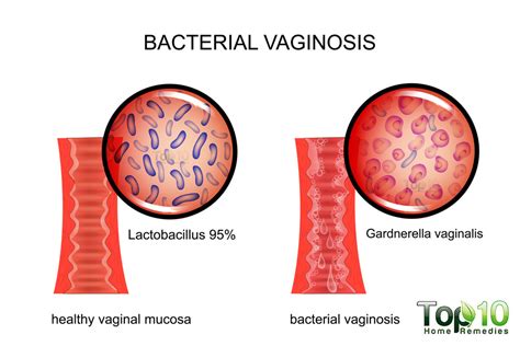 vaginosis bakteri