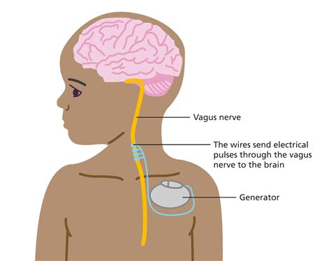 vagus nerve stimulation access your natural heali