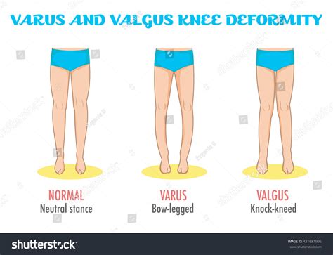 Valgus Vs Varus Deformity