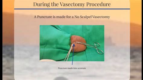 vasectomy بالعربي