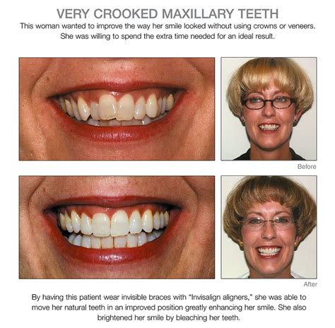 Veneers Before And After Crooked Teeth