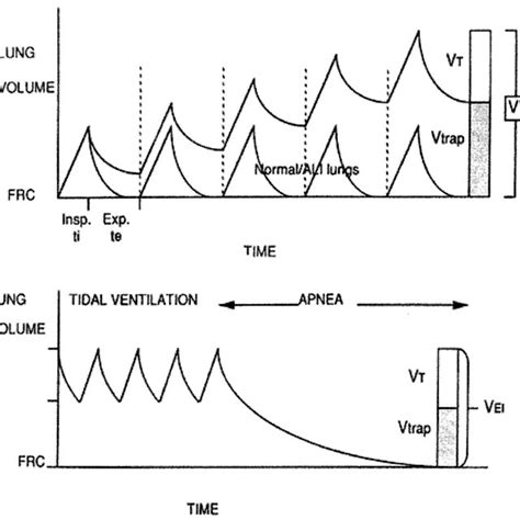 Download Ventilator Graphics And Respiratory Mechanics In The 