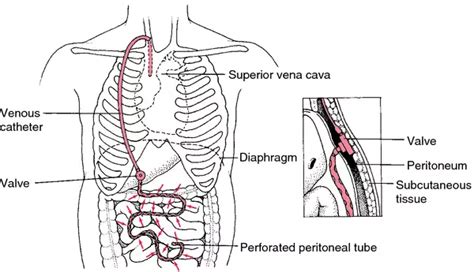 Ventro Medical Term