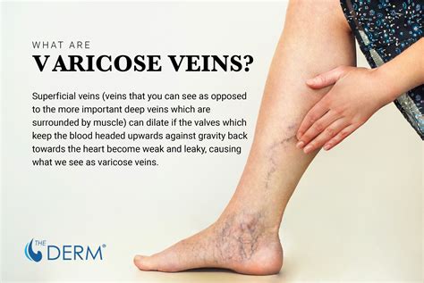 vericose veins and dating