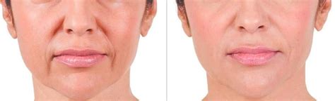 verminderen equivalent