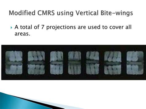 Vertical Bite Wings Are Often Used For Patients With: