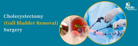 verwijdering procedure