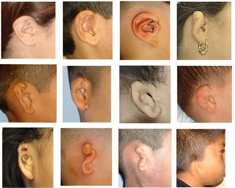Very Small Ears