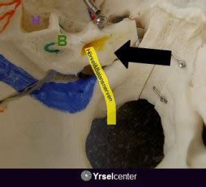 vestibularisneurit behandling