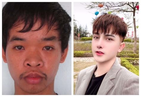 Vietnamese Spends Plastic Surgery