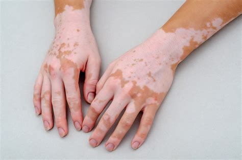 vitiligo adalah