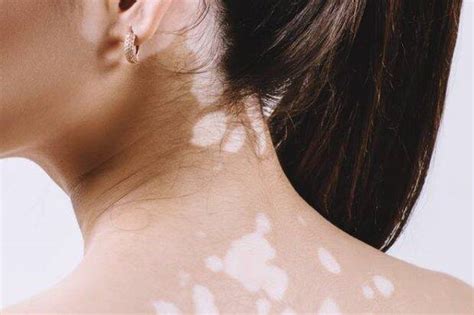 Vitiligo Gejala Penyebab Pengobatan Dll Hello Sehat Cara Mengatasi Vitiligo - Cara Mengatasi Vitiligo