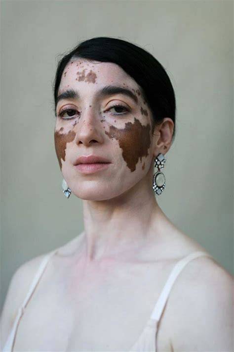 vitiligo nude