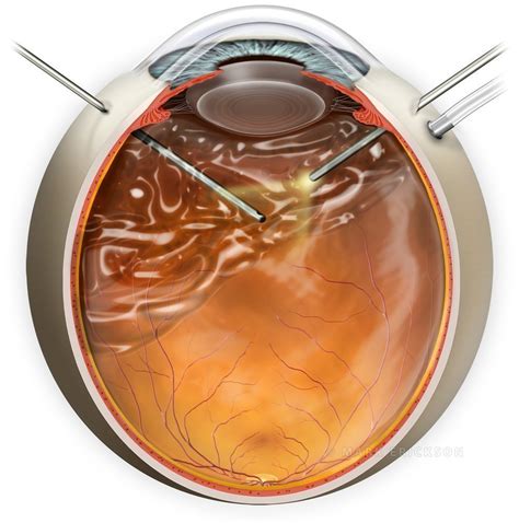 Vitreoretinal Surgery