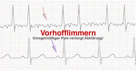 vorhofflimmern am puls erkennen