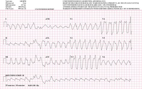 Vt On Ecg