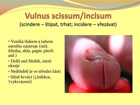 vulnus scissum adalah