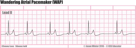 Wandering Atrial Pacemaker