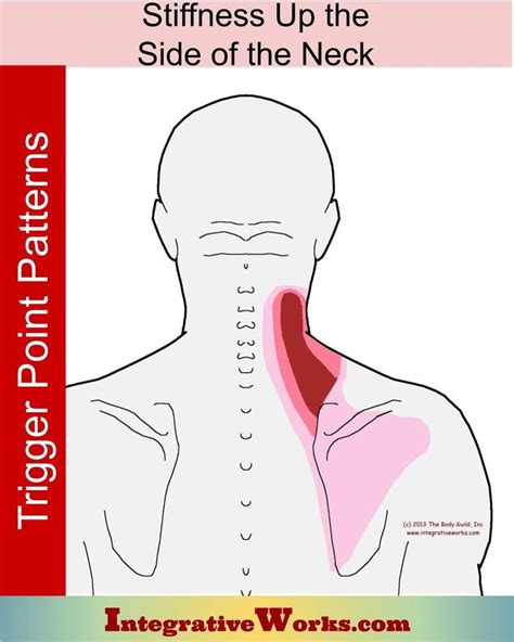 ways to describe kissing neck pain
