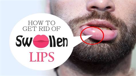 what can make a swollen lip go down
