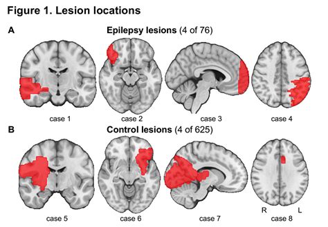What Cortex Lesion Would Cause Anosognosia