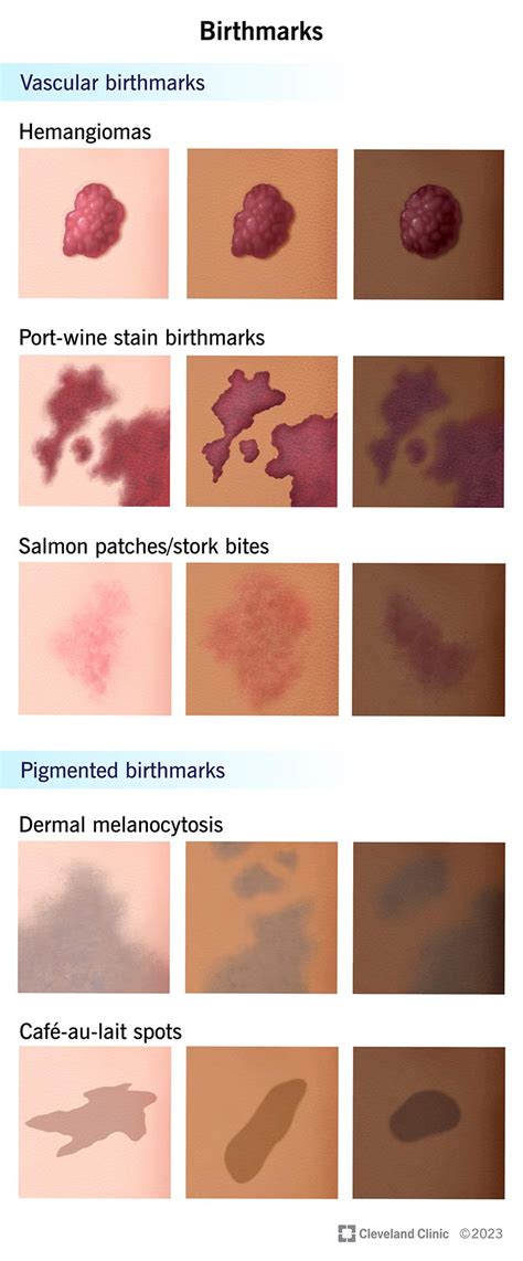 What Does A Birthmark Symbolize