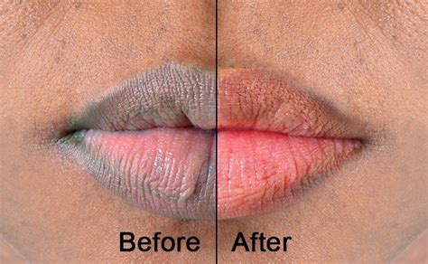 what does ice do to lips naturally